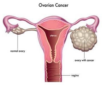 ovarian cancer is unde organele sunt parazitul principal