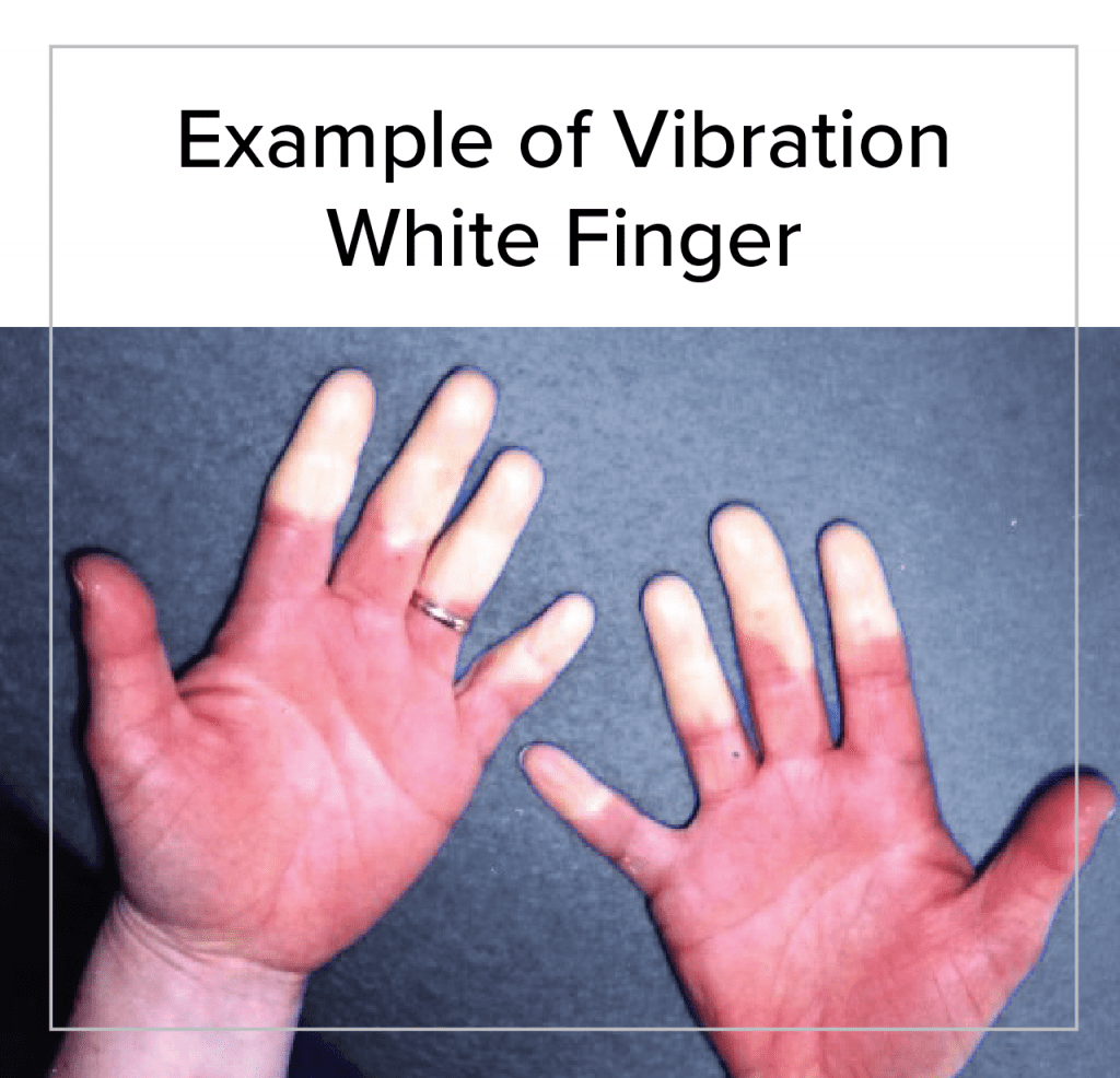 White finger example