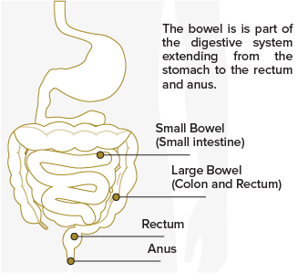 Bowel Cancer Graphic