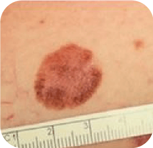 Skin Cancer Example