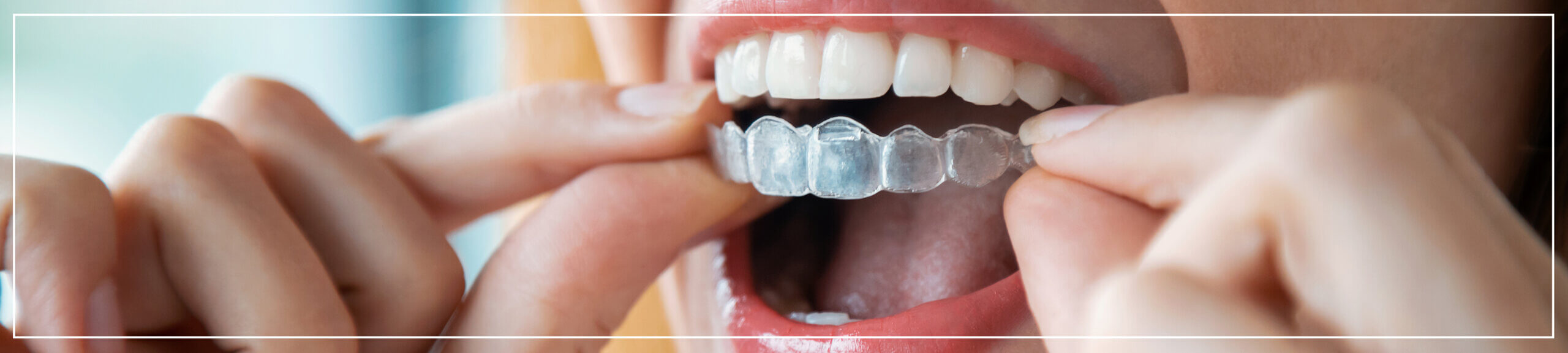 Damage caused by clear braces