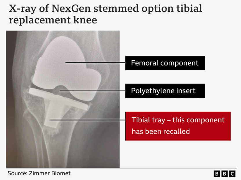 X-ray of NexGen knee replacement - BBC 